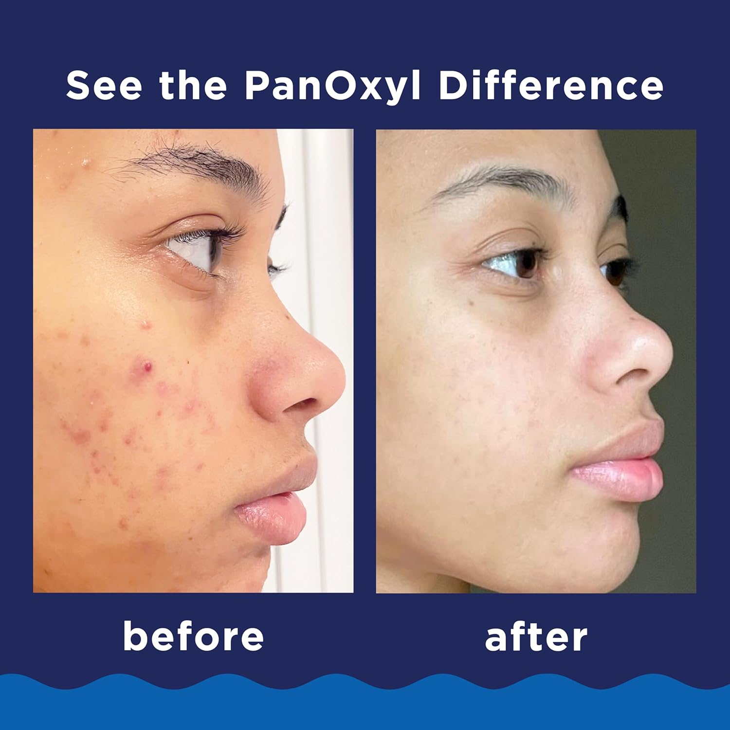 Powerful Foaming Cleanser for Stubborn Breakouts